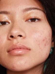 skinceuticals has a new antioxidant serum for oily and acne prone skin — allure