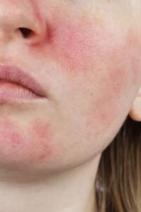 what causes sensitive skin?